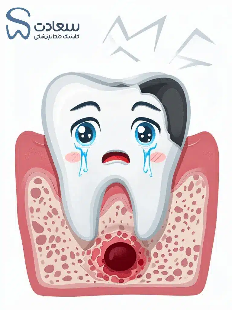 آیا جرم گیری باعث حساسیت دندان میشود؟